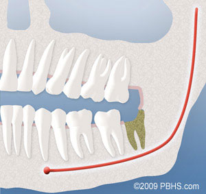 TruCare Dentistry Roswell - A dry socket is commonly seen after removing  the wisdom tooth. Read through this article to understand the cause, signs,  and treatment of a dry socket, usually after